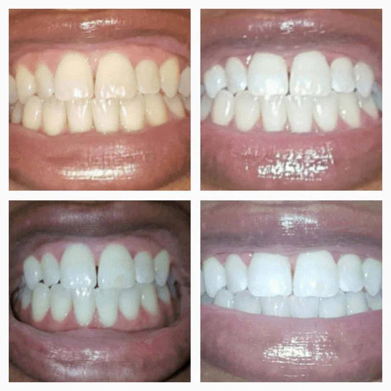 Flexienna™ Instant Whitening Pen